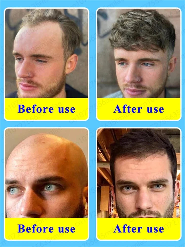 Hair Growth Solution for Baldness Treatment