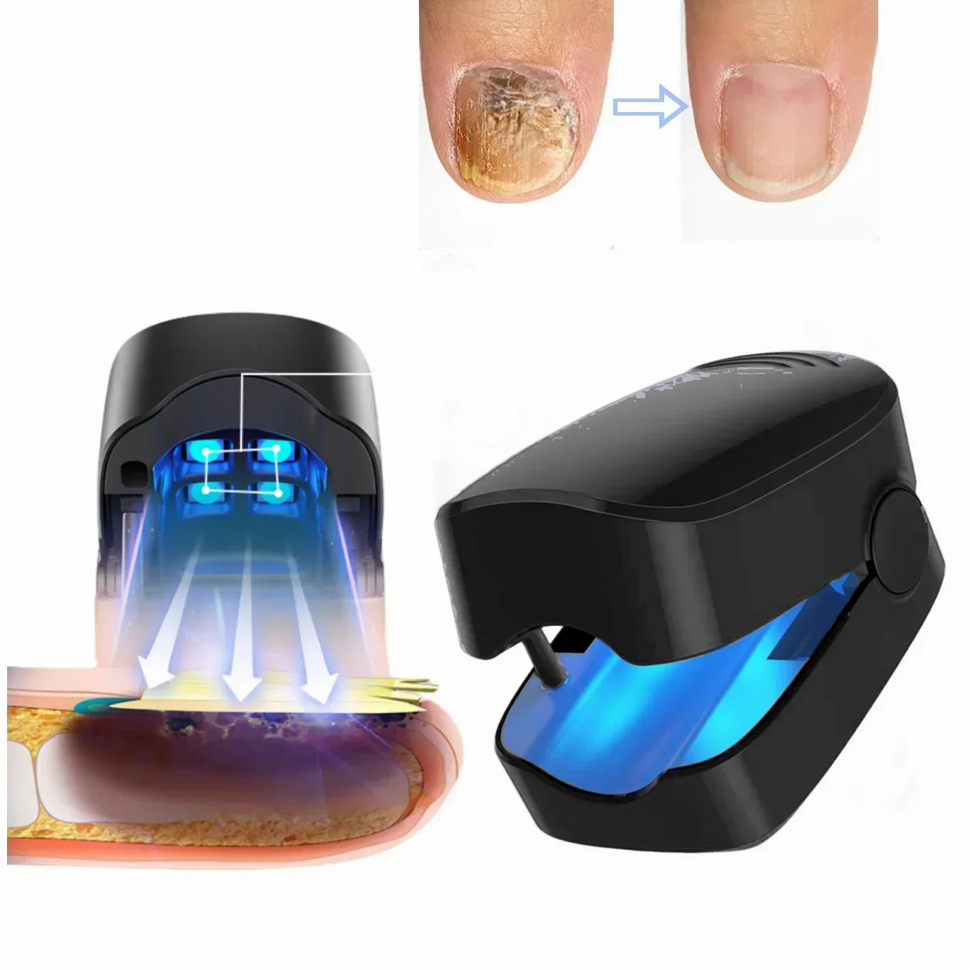 LED Laser Nail Fungus Treatment Device