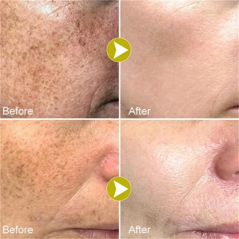 Face Melasma Cream