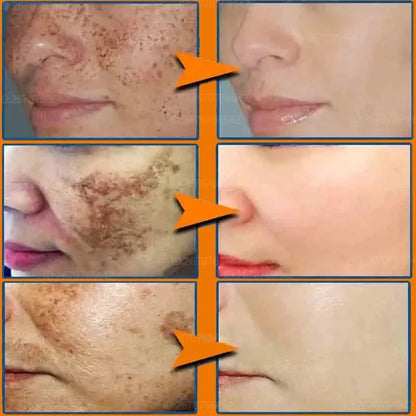 Face Melasma Cream