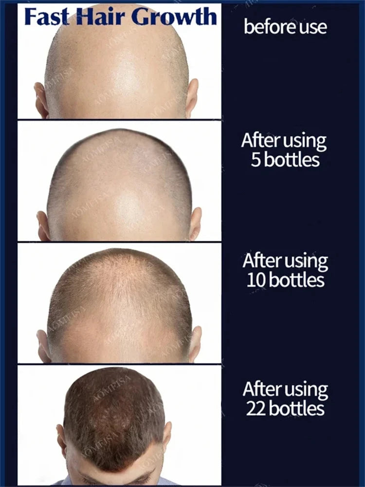 Hair Growth Solution for Baldness Treatment