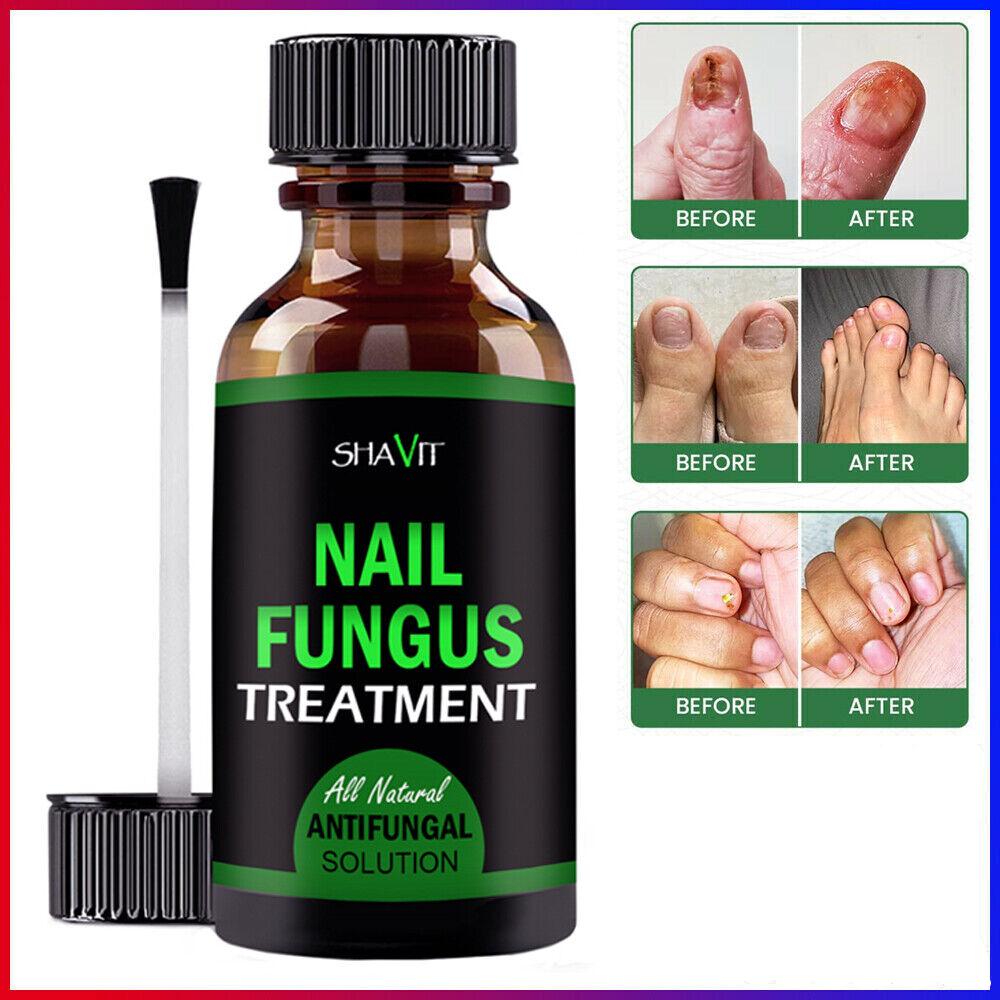 Anti-Fungal Treatment Extra Strength